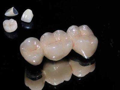 Răng sứ Cercon có những đặc tính vượt trội