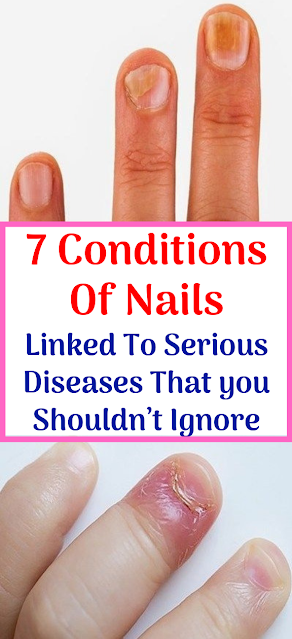 7 Common Nail Conditions Linked to Serious Diseases That You Shouldn’t Ignore