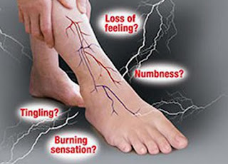 Numbness in legs | Numbness in legs and feet | Feeling numbness in legs