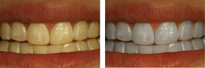Cara Memutihkan Gigi - cara, tips, memutihkan perawatan menjaga membuat gigi cepat alami yang kuning