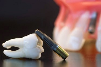 Trồng răng giả bằng implant