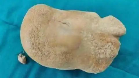 नाबालिक लड़के के पेट से डाक्टरों ने निकाला 1 किलो का पत्थर,जानिए कैसे बची 17 वर्षीय बालक की जान