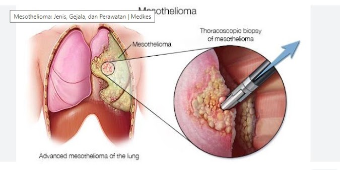 Asbestos and the Risk of Peritoneal Mesothelioma