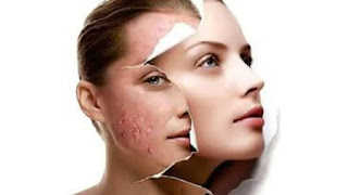 23 Remedios Caseros para eliminar el Acne, Barros y Espinillas