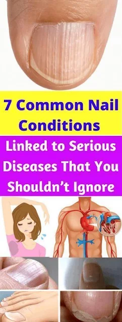 7 Common Nail Conditions Linked To Serious Diseases That You Should Not Ignore