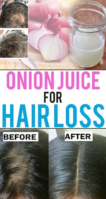 How to Make Onion Juice to Prevent Hair Loss