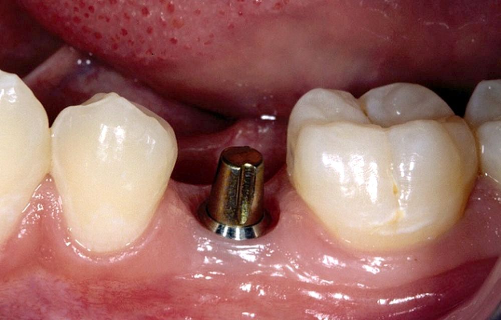 Dental Implant