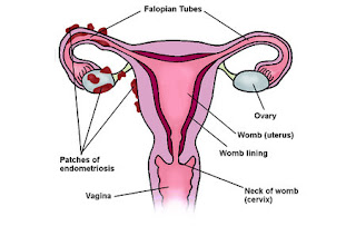 http://rashminursinghome.com/endometriosis-treatment-bangalore.html