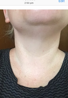 My neck taken by me after a month and a half of using Tightening Neck Therapy