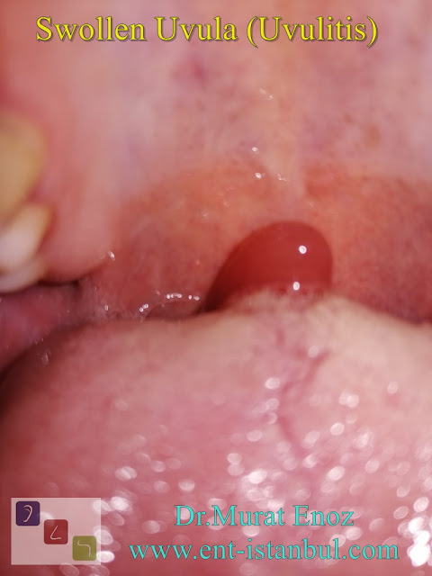 Swollen Uvula (Uvulitis)