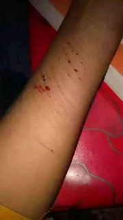 ব্লেড দিয়ে হাত কাটা পিক মেয়েদের