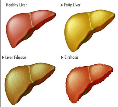 Pengertian Penyakit Fatty Liver, Gejala, Penyebab dan Pengobatan