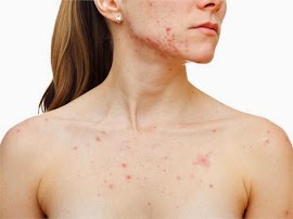 How To Get Rid of Chest Acne Naturally