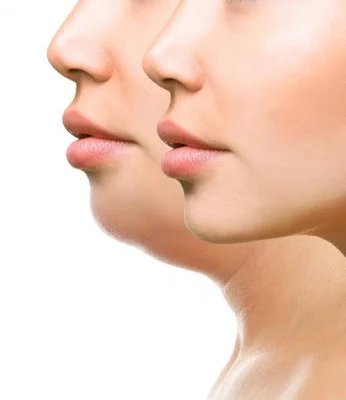 What Causes a Double Chin, Double Chin,Health,