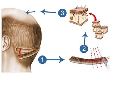 FUT Hair Transplant