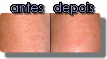 Foto Antes e depois da limpeza de pele profunda CBeauty