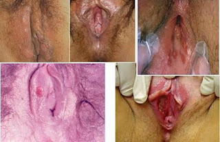 Obat Kencing Sakit Dan Bintik Merah Di Penis Vagina