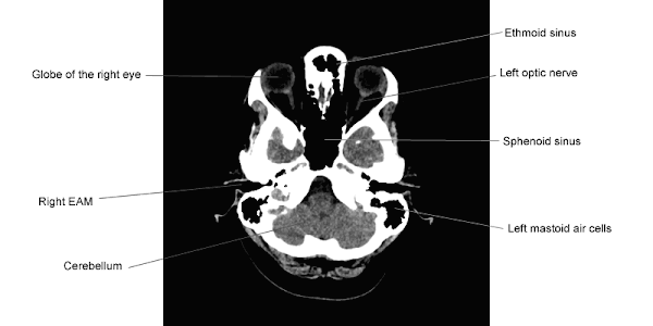 Gambaran Anatomi CT-Scan kepala