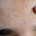 Latest Update on What Causes Acne Breakouts and How to Treat It