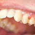 Viêm lợi có nhổ răng được không