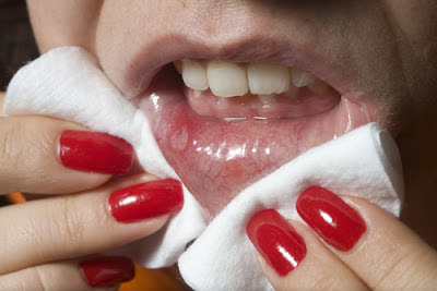 Mẹo chữa bệnh lở miệng bằng các phương pháp đơn giản