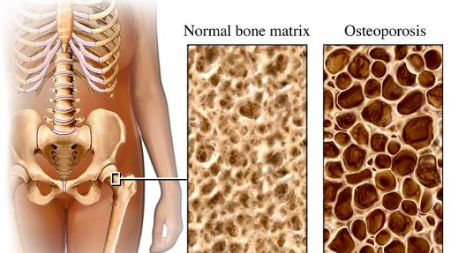 Cara Cegah osteoporosis Sejak Dini