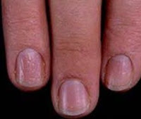 Vitamin Deficiency Vertical Ridges On Nails