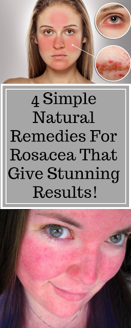 4 Simple Remedies to Treat Rosacea (Facial Redness & Broken Capillaries)