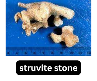 3.Struvite stone