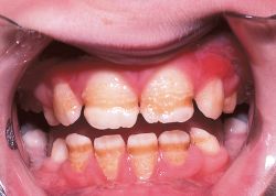 តើអ្វីជាEnamel Hypoplasia