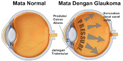 mata glaukoma