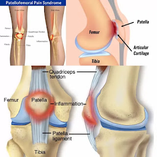 Patellofemoral pain Syndrome (PFPS)