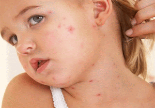 Measles is a very contagious disease