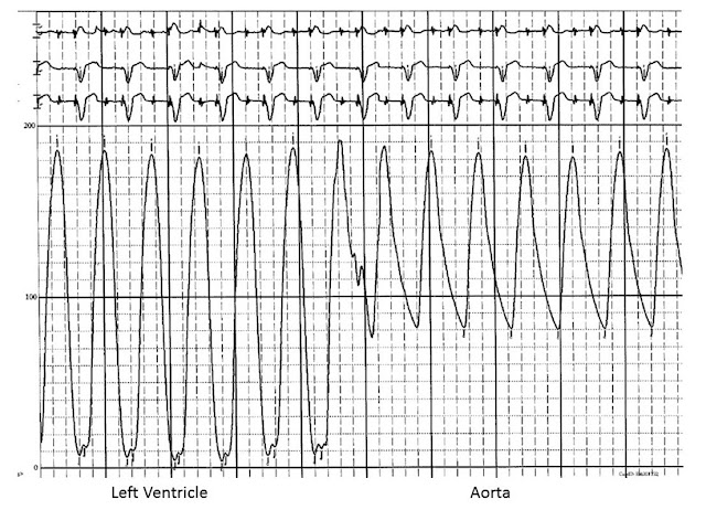 Pressure tracing during catheter pullback from the left ventricle to the aorta