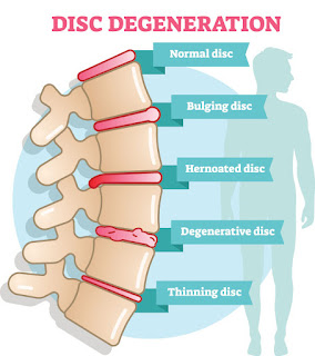 Disc Degeneration Process