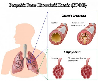 Obat Tradisional Penyakit Paru Obstruktif Kronis PPOK