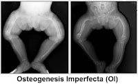 Osteogenesis Imperfecta (Oi Disease): Types, Symptoms, Diagnosis Inwards Add-On To Treatment