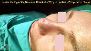 Breathe Implant à Wengen,4. revision nose job, Dent After Rhinoplasty, Complicated 4th Revision Rhinoplasty, Nasal contour irregularities, Postoperative dent issues, Revision rhinoplasty challenges, Rhinoplasty side effects, Nasal structural integrity,