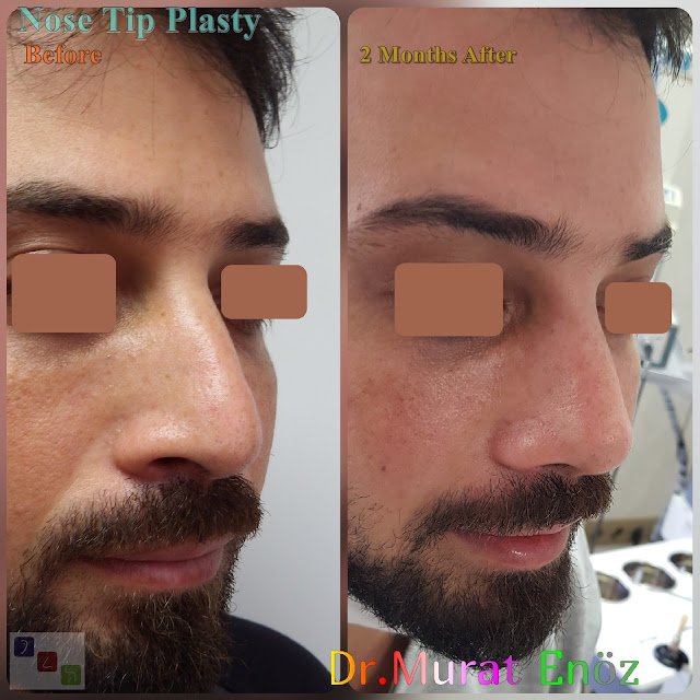 Male Nose Tip Plasty Surgery in Turkey,Nose Tip Reshaping For Men,Nose Tip Surgery For Men,Male Nose Tip Plasty Operation in Istanbul,Men's Nose Tip Plasty,