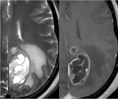 abnormal mri brain