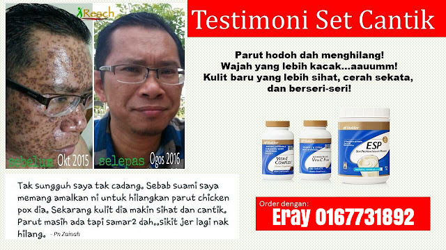 parut chicken pox, hilangkan parut chicken pox, reduce chicken pox scars, parut chicken pox berlubang, parut chicken pox timbul