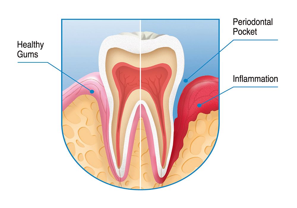 Bleeding Gums