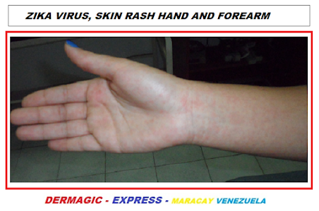 Virus zika erupción mano y antebrazo