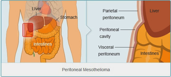 Peritoneal Mesothelioma