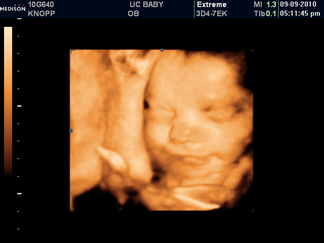 3d ultrasound 20 weeks pregnant. Update with 3D Ultrasound