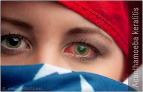 How common are Acanthamoeba Related Ocular Injuries in Contact Lens Wearers?