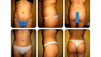 Brazilian Butt Lift For Men