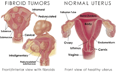 Natural Herbal Remedies on Fibroid Tumors  Natural Treatment   Herbal Remedies   B4tea Com