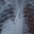 Menino de 3 anos morre após ficar um ano com prego no pulmão
