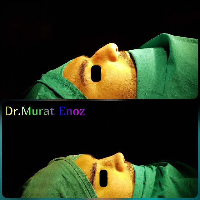 Rhinoplasty in men Istanbul - Male nose job Turkey